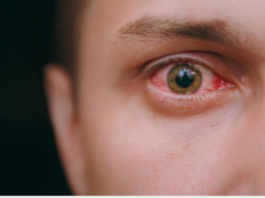 लाल आंखों का मतलब ही आंख आना (Eye Flu) नहीं, जान लीजिए किस किस बीमारी में आंखों का होता है बुरा हाल